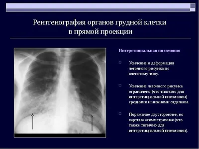 Рентгенография в диагностике заболеваний органов грудной  клетки:Учеб.пос.В.В.Мельников. 2017 - флипбук страница 101-150 | FlipHTML5