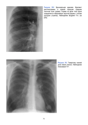 Рентгенография в диагностике заболеваний органов грудной  клетки:Учеб.пос.В.В.Мельников. 2017 - флипбук страница 101-150 | FlipHTML5