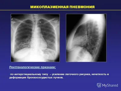 Рентгенография в диагностике заболеваний органов грудной клетки:Часть 2.  2018 - флипбук страница 51-76 | FlipHTML5