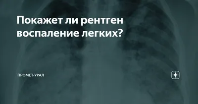 Редкий случай недиагностированного инородного тела бронха