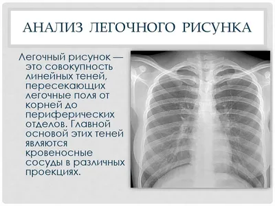 Усиление легочного рисунка на флюорографии: возможные причины, возможные  заболевания, отзывы