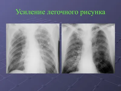 ОГК. Аномалии и варианты развития. Кистозная гипоплазия легкого. Врожденная  долевая эмфизема. Легочная секвестрация + | Портал радиологов