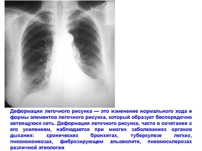 Презентация на тему: Изменения легочного рисунка