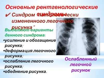 Усиление сосудистого рисунка легких на рентгене (50 фото) » Рисунки для  срисовки и не только