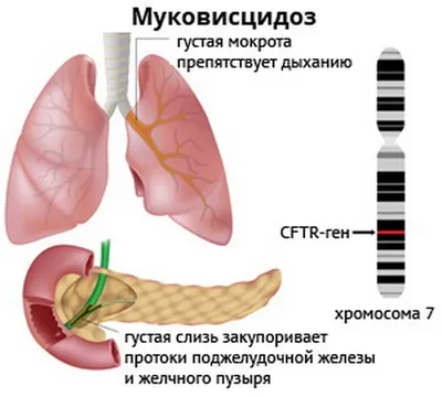 Легочная артериальная гипертензия