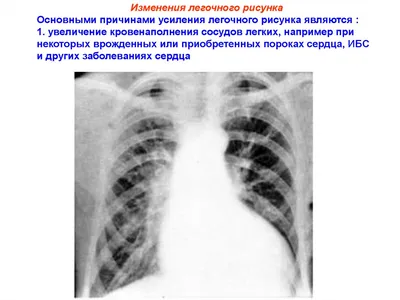 К вопросу о рентгенодиагностике плутониевого пневмосклероза – тема научной  статьи по клинической медицине читайте бесплатно текст  научно-исследовательской работы в электронной библиотеке КиберЛенинка