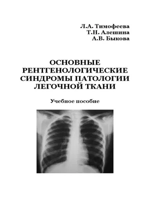 ОГК. Диссеминации. Рентгенодиагностика диффузных и диссеминированных  заболеваний легких. + | Портал радиологов