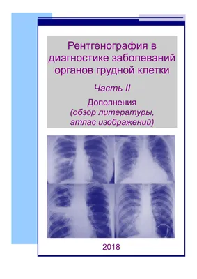 Фиброзирующий альвеолит легких – диагностика, симптомы и лечение