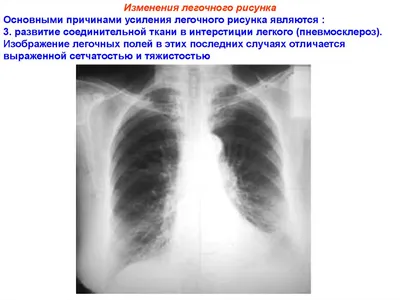 Основные рентгенологические синдромы патологии легочной ткани. Учеб.  пособие | PDF