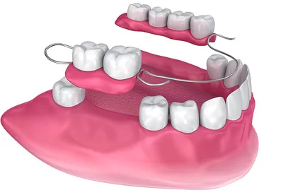 Съемное протезирование в стоматологической клинике «Доктор Дент» (г.  Йошкар-Ола), бюгельное протезирование зубов пенсионерам.