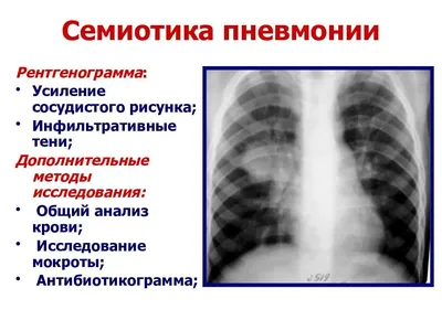 Усиление сосудистого рисунка (50 фото) » Рисунки для срисовки и не только