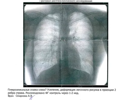 Потемнение и уплотнение в корне легкого. Выявление патологий на рентгене  легких