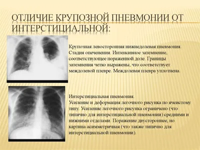 Будет ли видна пневмония на флюорографии? | MedAboutMe