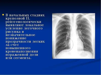 Диффузное усиление легочного рисунка что - 91 фото