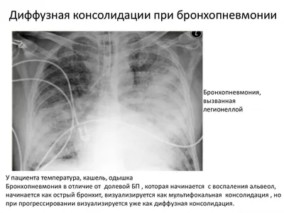 Основные рентгенологические синдромы ОГК. | ВКонтакте