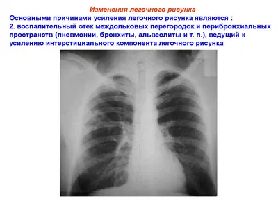 Диффузное усиление легочного рисунка что - 91 фото