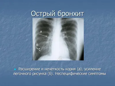 Усиление сосудистого рисунка легких на рентгене (50 фото) » Рисунки для  срисовки и не только