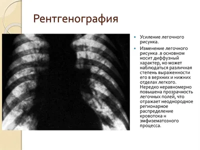 Диффузное усиление легочного рисунка за счет интрестициального компонента  (РМЖ в анамнезе)?? | Портал радиологов