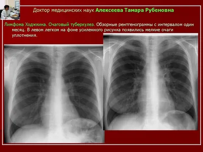 Презентация на тему: \"Рентген-синдромы в фтизиатрии Выполнила: Пинаева А.О.  Карагандинский государственный медицинский университет Кафедра  фтизиатрии.\". Скачать бесплатно и без регистрации.