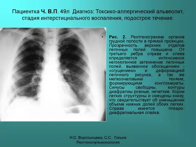 Усиленный легочный рисунок - Вопрос пульмонологу - 03 Онлайн